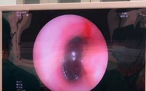 Chuyên gia cảnh báo: Trẻ nhỏ hóc hạt, ho sặc nghẹt đường thở doạ tử vong
