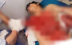 Tai nạn kinh hoàng: Ngã vào máy bóc gỗ, người đàn ông bị lột toàn bộ da phần ngực và tay