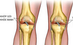 Bí quyết giúp hỗ trợ giảm đau nhức xương khớp khi trời lạnh