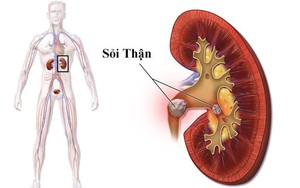 Ngoài uống nước, đây là những việc cần làm để ngăn ngừa sỏi thận, chăm sóc thận tốt nhất