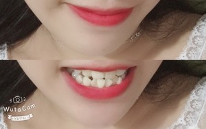 Có một nỗi đau mang tên răng 9-6-3-0: Đi đâu cũng tự ti, cười không dám cười lớn