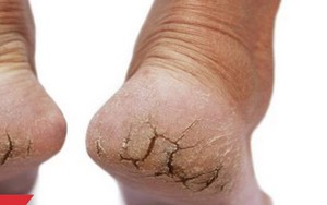 Có dấu hiệu này ở chân điều trị 1,2 tháng không hết phải nghĩ đến bệnh ung thư