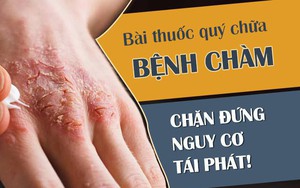 Bệnh chàm eczema: Dấu hiệu và cách chữa chặn đứng nguy cơ tái phát