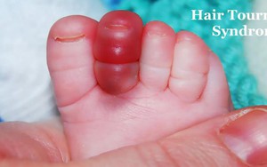 Cấp cứu hiếm gặp: Sợi tóc thít ngón chân bé 4 tháng tuổi, nữ y sĩ bó tay!