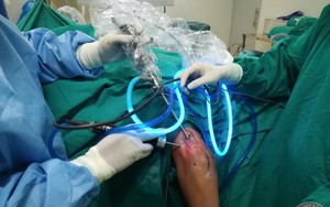 Bác sĩ kinh ngạc khi thấy hàng trăm viên sỏi trong khớp khuỷu của nam thanh niên 18 tuổi