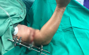 5 giờ kỳ diệu "hồi sinh" cánh tay đứt rời tưởng tàn phế cho bệnh nhân
