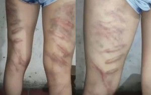 Không học thuộc bài, nữ sinh tiểu học bị cô dùng roi đánh dã man