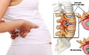 TS. BS Võ Xuân Sơn: Thoát vị đĩa đệm có thực sự đáng sợ?