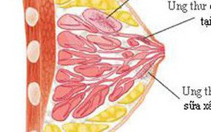 Tiến sĩ viện K chỉ 3 nguyên nhân gây ung thư vú và 1 việc bắt buộc phải làm để phòng bệnh