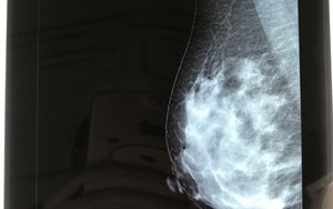 Chuyên gia ung bướu khuyến cáo: Không đặt túi ngực sau phẫu thuật vú vì nguy cơ này