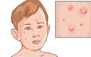 Thủy đậu đang vào mùa:  Dấu hiệu sớm nhất, cách chăm sóc và phòng bệnh bạn nên làm ngay