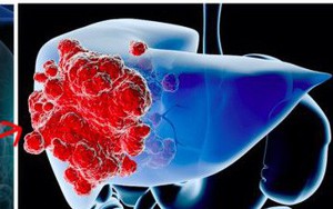 Ung thư gan đứng đầu trong các bệnh ung thư ở VN: GĐ BV Ung bướu chỉ 5 dấu hiệu cảnh báo