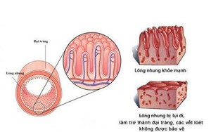 Viêm đại tràng mạn tính - điều trị sao cho đúng?