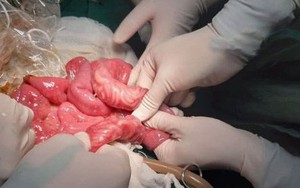 Kinh hãi cháu bé 3 tuổi bị giun ken tắc ruột