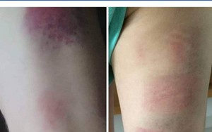 Cuộc điện thoại khiến phụ huynh bức xúc của cô chủ nhiệm bị tố đánh 22 học sinh