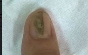 Kẻ sọc trên ngón tay: Dấu hiệu căn bệnh khiến người mắc ngại không dám... lấy chồng