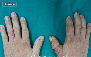 BS nghẹt thở nối ngón tay đứt lìa cho bệnh nhân tiểu đường lớn tuổi nhất từ trước đến nay