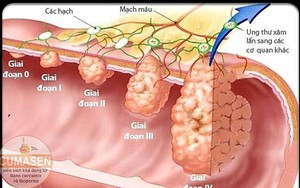 Các giai đoạn của ung thư đại tràng