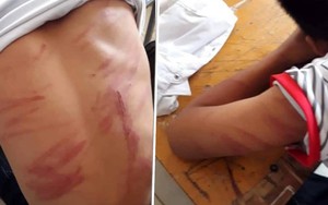 [NÓNG] Học sinh lớp 8 đến trường với cơ thể chằng chịt vết thương, nói 'bị bố đánh'
