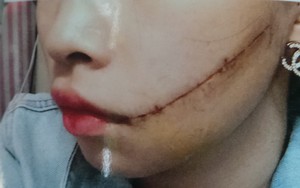Người phụ nữ có gia đình bị người tình rạch mặt khi đang âu yếm vì cùng lúc quen nhiều người
