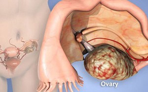Bác sĩ mắt đỏ hoe giải thích cho cô gái trẻ phát hiện mắc ung thư khi chưa kịp lập gia đình