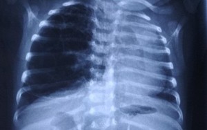 BV Việt Đức vừa gặp trường hợp cực hiếm: Em bé có lá phổi "khủng" đè lệch tim và khí quản