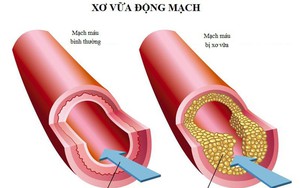 Tẩy sạch mạch máu để ngăn ngừa đột quỵ dựa vào công thức "3 cao, 4 thấp" nổi tiếng Đông y