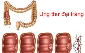 BS khuyến cáo: Uống 1 lon nước ngọt/ngày, ung thư xuất hiện sớm, ác tính hóa nhanh