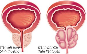 Chuyên gia lý giải nguyên nhân gây phì đại tuyến tiền liệt ở nam giới, triệu chứng và phương pháp điều trị