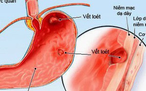 Dấu hiệu sớm của ung thư dạ dày: Nếu biết để phát hiện kịp thời, cơ hội khỏi bệnh rất cao