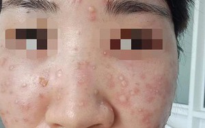 Ham làm đẹp, người phụ nữ hoảng hốt mặt nổi toàn mụn... lạ