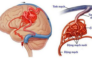 Đang dự thi, thí sinh Hà Tĩnh đột ngột liệt nửa người: Căn bệnh nguy hiểm thế nào?