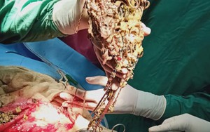 Bác sĩ “giật mình” khi phát hiện gần 1,6kg trang sức cùng 1,5 tỷ đồng nằm gọn trong dạ dày người phụ nữ bởi một hội chứng bí ẩn