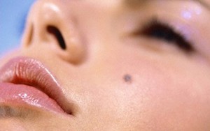 Nốt ruồi tẩy sai cách có thể kích hoạt tế bào ung thư: Khuyến cáo từ chuyên gia hàng đầu về da liễu