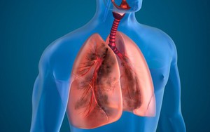 Bác sĩ cảnh báo dấu hiệu sớm của căn bệnh phổi nguy hiểm: Tấn công cả người trẻ tuổi