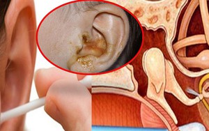 Trả giá đắt: Suýt viêm màng não vì cái bông tăm