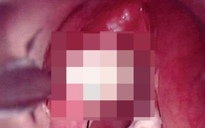 Triệu chứng dễ nhầm với cảm cúm nhưng là dấu hiệu duy nhất của một loại bệnh ung thư