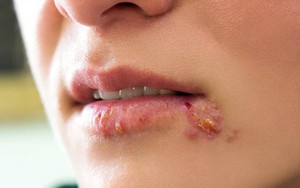 BS Da liễu cảnh báo: Không hiếm trẻ 14, 15 tuổi đã mắc bệnh lây nhiễm qua đường tình dục