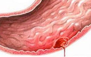 Thủng dạ dày vì thói quen khó bỏ của nhiều người Việt