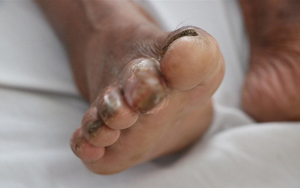 Người đàn ông ở Hà Tĩnh bị vi khuẩn "ăn thịt người" tấn công ngón chân