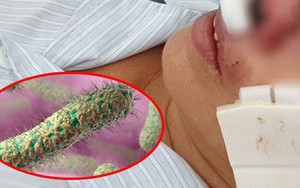 BS Trương Hữu Khanh: Không cần hoảng loạn vì thứ vi khuẩn đang được cho là "ăn thịt người"