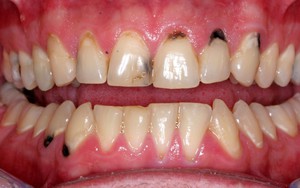 Chân răng bị đen có nguy hiểm không: Giải pháp làm trắng và ngăn ngừa răng xỉn màu