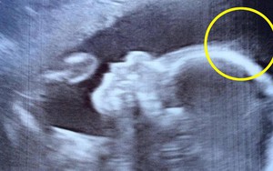 Mẹ lo sợ thấy dấu hiệu lạ trên đầu thai khi siêu âm, không ngờ con chào đời đã nổi tiếng, ngàn người hâm mộ
