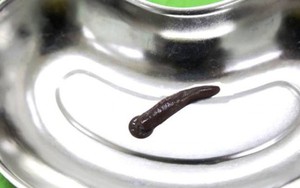 Kinh hoàng: Đỉa trâu 10cm, to bằng ngón tay sống trong cổ họng người đàn ông