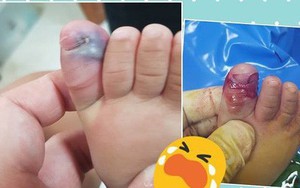 Bé 10 tháng tuổi bị hoại tử ngón chân cái và suýt phải cưa bỏ vì sự lo lắng sai lầm của người mẹ