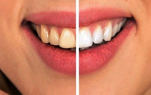 7 cách đơn giản ngăn ngừa sâu răng mà không phải ai cũng biết