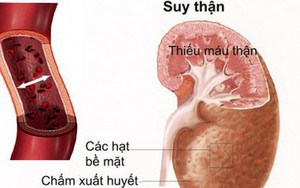 Phòng ngừa và điều trị bệnh lao thận hiệu quả