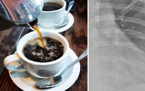 Người phụ nữ 30 tuổi này đã uống 10 tách cà phê mỗi ngày và bác sĩ đã sửng sốt khi nhìn kết quả X-quang của cô