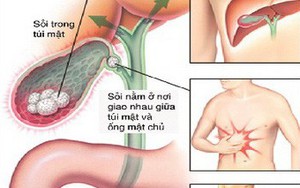 Phát hiện và điều trị sớm bệnh sỏi mật