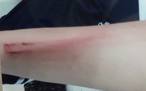 Cha đánh con gái 12 tuổi nhập viện